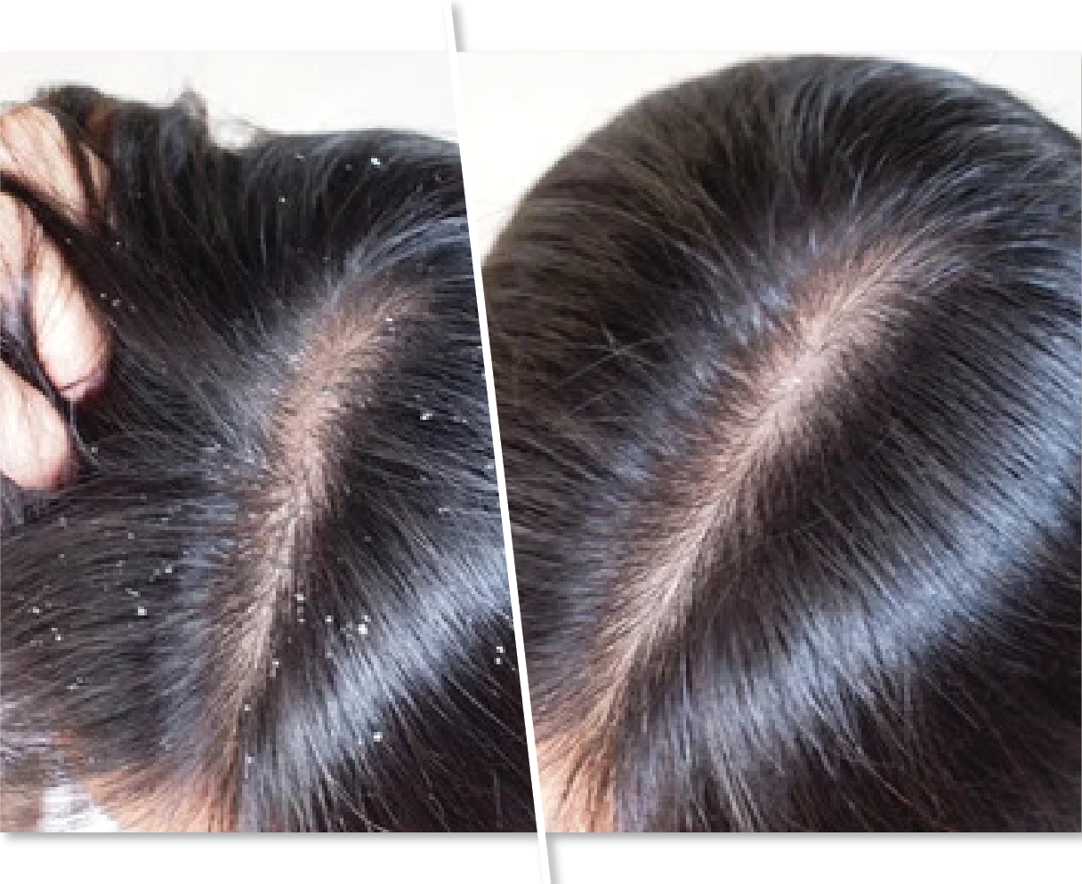 Before and After Anti Dandruff Treatment